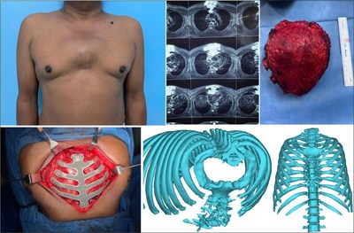 印度医院3D打印钛合金胸骨植入物，拯救了癌症患者的生命