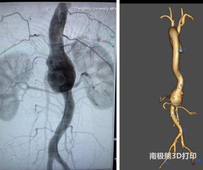 “3D打印”技术助力治疗高难度主动脉瘤