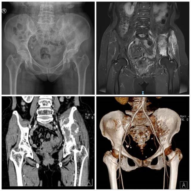 柳州58岁阿姨肠癌十多年后又患巨大骨肉瘤，医生“精准拆弹”利用3D打印重建骨盆假体