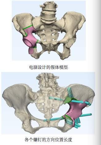 骨盆也能“量身定制”，65岁阿姨装上了3D打印的半个骨盆