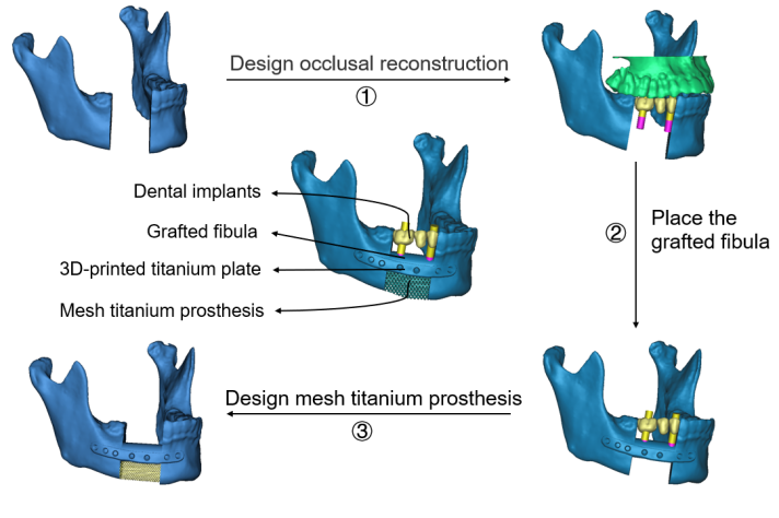 3D打印钛植入物与血管化腓骨移植“组装式”手术重建下颌骨
